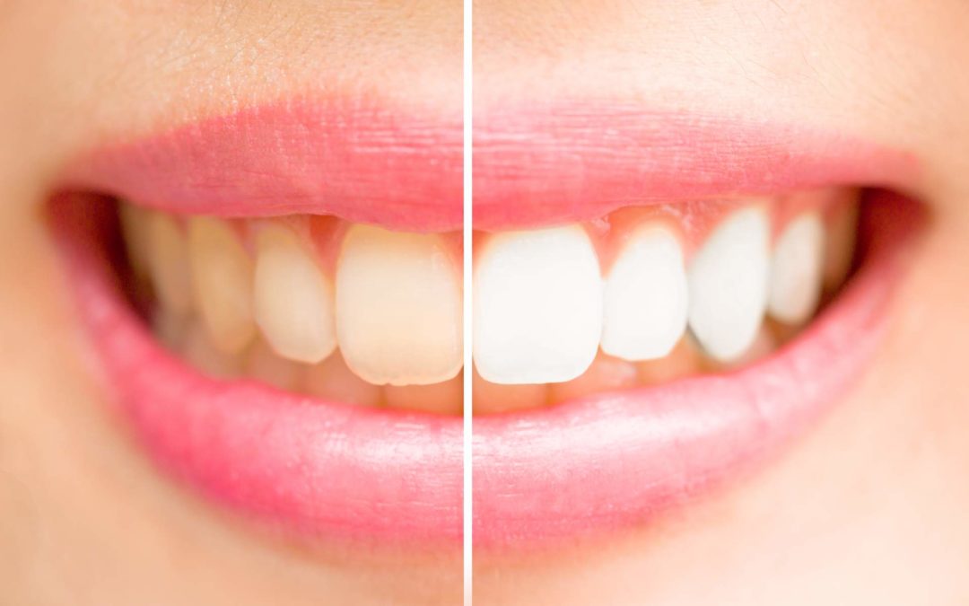 Licówki porcelanowe: szybki i bezpieczny sposób zatuszowania niedoskonałości zębów