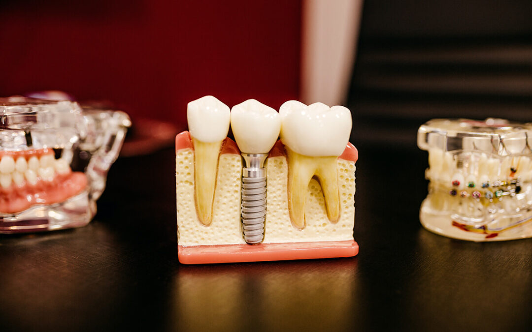 Czym jest mikroimplant ortodontyczny?