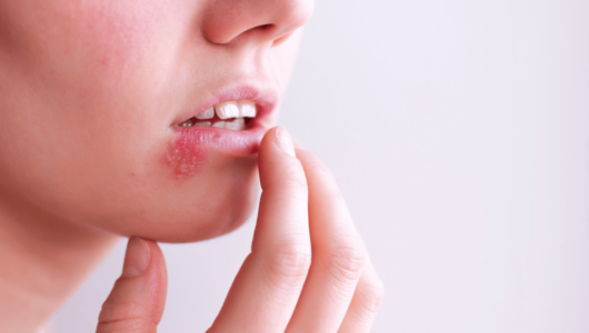 Czy z opryszczką można iść do dentysty?