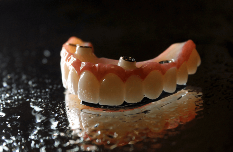 Implanty zębowe od lat uważane są za najbardziej zaawansowaną formę odbudowy brakujących zębów. Głównym powodem ich popularności jest nie tylko trwałość i skuteczność, ale przede wszystkim to, jak bardzo przypominają naturalne zęby – zarówno wizualnie, jak i funkcjonalnie. W przeciwieństwie do ruchomych protez czy mostów, implanty są mocowane bezpośrednio w kości szczęki lub żuchwy. Dzięki temu doskonale naśladują naturalny korzeń zęba i zapewniają stabilność, jakiej nie gwarantuje żadna inna metoda protetyczna. Pacjenci, którzy zdecydowali się na implanty, często podkreślają, że po krótkim czasie zupełnie zapominają o ich istnieniu. Mowa, żucie, a nawet uśmiechanie się odzyskują pełen komfort i swobodę. Co więcej, dzięki nowoczesnym technologiom implantologicznym korona zęba osadzona na implancie jest niemal nie do odróżnienia od zdrowego zęba. Jej kolor, kształt i przezierność są indywidualnie dopasowywane do reszty uzębienia, co daje bardzo naturalny efekt końcowy. To właśnie symbioza estetyki i funkcjonalności sprawia, że implanty uznaje się dziś za złoty standard w leczeniu ubytków zębowych. Dają pacjentowi poczucie, jakby odzyskał własny ząb, a nie jedynie jego sztuczny zamiennik. Nic więc dziwnego, że tak wielu stomatologów rekomenduje tę formę leczenia jako najlepszą możliwą opcję. Kiedy warto rozważyć zabieg wszczepienia implantów Brak jednego lub kilku zębów to nie tylko problem estetyczny. W dłuższej perspektywie może prowadzić do poważnych zaburzeń zgryzu, przeciążeń pozostałych zębów, a także zaniku kości w miejscu ubytku. Dlatego decyzja o uzupełnieniu braków powinna być podjęta jak najszybciej. Implanty zębowe są doskonałym rozwiązaniem w wielu przypadkach, ale szczególnie zaleca się je osobom, które utraciły ząb w wyniku urazu, choroby przyzębia lub ekstrakcji z powodu próchnicy. Warto rozważyć implant również wtedy, gdy chcemy uniknąć szlifowania zdrowych zębów pod koronę lub most. Wszczepienie implantu pozwala na zachowanie struktury sąsiadujących zębów, co w dłuższej perspektywie przekłada się na lepsze zdrowie całej jamy ustnej. To ważne zwłaszcza u osób młodych, które z różnych przyczyn utraciły ząb i chcą cieszyć się pięknym uśmiechem przez wiele lat. Zabieg implantacji jest szczególnie polecany pacjentom ceniącym wygodę i naturalność. Dzięki niemu można bez obaw jeść wszystkie potrawy, mówić i śmiać się, nie martwiąc się o przesunięcie czy wypadnięcie uzupełnienia protetycznego. Implanty nie wymagają również specjalistycznej pielęgnacji – wystarczy codzienna higiena jamy ustnej oraz regularne wizyty u dentysty. Dlaczego implanty są bardziej trwałe niż inne rozwiązania Trwałość to jeden z kluczowych powodów, dla których implanty zębowe cieszą się tak dużym uznaniem wśród pacjentów i specjalistów. Wszczepione w kość tytanowe śruby stają się z nią zintegrowane w procesie osteointegracji, co sprawia, że są one niemal tak stabilne jak naturalne korzenie zębów. To ogromna przewaga nad mostami czy protezami, które z czasem mogą się przesuwać, wypadać lub wymagać częstych korekt. Implanty wykazują niezwykle wysoką odporność na uszkodzenia mechaniczne i działanie sił żucia. Jeśli są prawidłowo wykonane i odpowiednio pielęgnowane, mogą służyć pacjentowi przez całe życie. Warto zaznaczyć, że podczas gdy klasyczne korony i mosty często wymagają wymiany po 10–15 latach, implanty bardzo często pozostają w dobrym stanie przez dziesięciolecia. Nie bez znaczenia pozostaje też fakt, że implanty zapobiegają zanikowi kości, co często zdarza się po usunięciu zęba. Dzięki temu zachowujemy prawidłowy kształt szczęki i unikamy zapadania się policzków, które wizualnie dodaje lat. To wszystko przekłada się na większy komfort życia i lepsze samopoczucie psychiczne. Jak wygląda proces leczenia implantologicznego krok po kroku Zabieg wszczepienia implantu zębowego jest procedurą wieloetapową, ale dzięki nowoczesnym technikom i precyzyjnemu planowaniu nie jest ani bolesny, ani nadmiernie uciążliwy dla pacjenta. Wszystko zaczyna się od konsultacji, podczas której stomatolog ocenia stan zdrowia jamy ustnej, wykonuje zdjęcia RTG lub tomografię komputerową i planuje leczenie. Kluczowe jest upewnienie się, że pacjent ma wystarczającą ilość kości, by utrzymać implant. W przypadku jej niedoboru można zastosować przeszczep kości lub zabieg podniesienia dna zatoki szczękowej. Sam zabieg implantacji polega na wprowadzeniu tytanowej śruby w miejsce brakującego zęba. Przeprowadza się go w znieczuleniu miejscowym, a całość trwa zazwyczaj od 30 minut do godziny. Następnie implant musi się zintegrować z kością – proces ten trwa od 3 do 6 miesięcy, w zależności od indywidualnych predyspozycji pacjenta. Po zakończeniu osteointegracji osadza się tzw. łącznik, który łączy implant z koroną zęba. Finalnym etapem jest wykonanie i założenie korony protetycznej – jej kształt, kolor i materiał są zawsze dobierane indywidualnie. Efektem jest ząb, który wygląda i funkcjonuje jak naturalny. Cały proces może zająć kilka miesięcy, ale końcowy efekt rekompensuje czas oczekiwania. Co wyróżnia implanty zębowe spośród innych metod W porównaniu z innymi metodami uzupełniania braków zębowych, implanty wyróżniają się jakością, funkcjonalnością i długoterminową opłacalnością. Protezy ruchome mogą być tańsze i szybsze w wykonaniu, ale zazwyczaj wymagają regularnych poprawek, mogą powodować dyskomfort i ograniczać codzienne funkcjonowanie. Mosty z kolei wymagają oszlifowania zdrowych zębów, co może prowadzić do ich osłabienia i problemów w przyszłości. Implanty eliminują te niedogodności. Dzięki integracji z kością stanowią trwałe podparcie dla korony i nie wpływają negatywnie na sąsiednie zęby. Co więcej, odpowiednio dobrane implanty pozwalają przywrócić pełną funkcjonalność zgryzu, co jest kluczowe nie tylko dla komfortu życia, ale również dla zdrowia układu pokarmowego i mowy. Estetyka to kolejna mocna strona implantów. Nowoczesne korony porcelanowe lub cyrkonowe mogą być wykonane z ogromną precyzją, dzięki czemu nie odróżniają się od naturalnych zębów. W efekcie pacjenci nie tylko odzyskują możliwość swobodnego jedzenia i mówienia, ale też znów mogą uśmiechać się bez skrępowania. Kto może skorzystać z leczenia implantologicznego Leczenie implantologiczne może być stosowane u bardzo szerokiego grona pacjentów. Nie istnieje górna granica wieku – ważniejszy niż metryka jest ogólny stan zdrowia pacjenta oraz kondycja kości w miejscu planowanego wszczepienia. Implanty można stosować zarówno przy pojedynczych brakach zębowych, jak i w przypadku bezzębia, tworząc na ich bazie większe rekonstrukcje protetyczne, jak mosty lub protezy całkowite mocowane na implantach. Oczywiście istnieją pewne przeciwwskazania względne lub bezwzględne, takie jak niekontrolowana cukrzyca, choroby nowotworowe, nieleczona osteoporoza czy nałogowe palenie tytoniu. W takich przypadkach decyzję o leczeniu implantologicznym podejmuje się ostrożnie, po dokładnej analizie stanu zdrowia i ewentualnym przygotowaniu organizmu do zabiegu. Warto również wspomnieć o młodszych pacjentach. Implantów nie wykonuje się u osób, u których proces wzrostu kości nie został jeszcze zakończony – najczęściej poniżej 18. roku życia. U dorosłych natomiast nie ma przeciwwskazań wiekowych, o ile kość jest odpowiednio rozwinięta i zdrowa. W każdym przypadku leczenie rozpoczyna się od dokładnej diagnostyki i indywidualnego planu, co gwarantuje bezpieczeństwo i skuteczność terapii. Jakie materiały stosuje się w implantach zębowych Implanty zębowe wykonywane są najczęściej z tytanu, który ze względu na swoje właściwości biokompatybilne doskonale integruje się z tkanką kostną. Tytan jest odporny na korozję, nie uczula, a jego mechaniczne właściwości pozwalają mu pełnić funkcję stabilnego „korzenia” zębowego przez wiele lat, a nawet całe życie pacjenta. W ostatnich latach coraz większą popularnością cieszą się również implanty wykonane z cyrkonu – materiału ceramicznego o wysokiej estetyce i doskonałej tolerancji biologicznej. Wybór materiału zależy w dużej mierze od indywidualnych preferencji pacjenta oraz wskazań lekarza. Tytan ma długą historię kliniczną i cechuje się bardzo wysoką skutecznością, jednak niektórzy pacjenci poszukują alternatyw bezmetalowych – wtedy warto rozważyć implanty cyrkonowe. Są one szczególnie polecane osobom z cienkim dziąsłem lub wysokimi wymaganiami estetycznymi, ponieważ są białe i nie prześwitują przez tkanki. Oprócz samego implantu, bardzo istotnym elementem całego systemu jest korona protetyczna. Może być ona wykonana z porcelany na podbudowie metalowej, z pełnej ceramiki lub cyrkonu. Każde z tych rozwiązań ma swoje zalety i zastosowania – np. porcelana na metalu sprawdza się dobrze w bocznych odcinkach, gdzie liczy się przede wszystkim wytrzymałość, natomiast korony pełnoceramiczne lub cyrkonowe oferują najwyższą estetykę w odcinku przednim. Nie bez znaczenia są również technologie wspomagające produkcję implantów i koron – obecnie wiele laboratoriów korzysta z projektowania CAD/CAM, co umożliwia bardzo precyzyjne odwzorowanie anatomii zęba i idealne dopasowanie elementów do jamy ustnej pacjenta. To wszystko sprawia, że implanty nie tylko są trwałe, ale też niemal nieodróżnialne od naturalnego uzębienia. Jakie korzyści estetyczne niosą nowoczesne implanty Jednym z najważniejszych atutów implantów zębowych jest ich estetyka. Dobrze zaprojektowany i wykonany implant z koroną potrafi tak wiernie odwzorować naturalny ząb, że nawet osoby z najbliższego otoczenia pacjenta nie są w stanie rozpoznać, który ząb jest sztuczny. Kluczową rolę odgrywa tutaj odpowiednie planowanie leczenia oraz zastosowanie nowoczesnych technologii, które pozwalają idealnie odwzorować kształt, kolor i przezierność korony zęba. Nowoczesne korony protetyczne mogą być wykonane z materiałów, które perfekcyjnie imitują szkliwo – dotyczy to zwłaszcza koron pełnoceramicznych oraz tych wykonanych z tlenku cyrkonu. Ich powierzchnia odbija światło w bardzo podobny sposób jak naturalny ząb, a dodatkowo są odporne na przebarwienia, co ma ogromne znaczenie w dłuższej perspektywie użytkowania. Dzięki implantom pacjenci mogą odzyskać piękny, symetryczny uśmiech bez uczucia sztuczności, jakie często towarzyszy noszeniu protez ruchomych. Dla wielu osób to ogromna zmiana jakości życia – nie muszą już wstydzić się uśmiechu, unikają niekomfortowych sytuacji społecznych i zyskują na pewności siebie. Zwłaszcza w zawodach, gdzie kontakt z klientem lub wystąpienia publiczne są codziennością, estetyka uśmiechu ma kolosalne znaczenie. Implanty eliminują także problem zapadania się tkanek miękkich, który często występuje po utracie zęba – szczególnie w odcinku przednim. Brak korzenia powoduje bowiem zanik kości, co wpływa na wygląd dziąseł i kształt twarzy. Implanty, jako że integrują się z kością, zapobiegają tym niekorzystnym zmianom, podtrzymując naturalną strukturę tkanek i przyczyniając się do zachowania młodszego wyglądu. Czy implanty wymagają specjalnej pielęgnacji i kontroli Jednym z mitów na temat implantów zębowych jest przekonanie, że wymagają one specjalnej, skomplikowanej pielęgnacji. W rzeczywistości ich codzienne utrzymanie w dobrym stanie jest bardzo zbliżone do higieny naturalnych zębów. Wystarczy regularne szczotkowanie dwa razy dziennie, stosowanie nici dentystycznej lub irygatora oraz okresowe wizyty kontrolne u dentysty i higienistki. Co istotne, implanty – podobnie jak naturalne zęby – mogą być zagrożone przez choroby przyzębia. Mimo że sam tytan nie ulega próchnicy, tkanki otaczające implant są wrażliwe na bakterie i stany zapalne. Dlatego tak ważna jest dokładność w codziennej higienie oraz profilaktyczne zabiegi higienizacji, które pozwalają usunąć kamień nazębny i zapobiec rozwojowi periimplantitis – czyli zapalenia tkanek wokół implantu. Ważną rolę w długowieczności implantów odgrywa również nawyk niepalenia papierosów. Nikotyna wpływa negatywnie na ukrwienie dziąseł, co może utrudniać integrację implantu z kością i zwiększać ryzyko powikłań. Z tego względu wielu implantologów zaleca całkowitą rezygnację z palenia przynajmniej na czas leczenia i gojenia się tkanek. Regularne wizyty u stomatologa są kluczowe dla utrzymania zdrowia jamy ustnej i samego implantu. Specjalista sprawdzi, czy nie dochodzi do przeciążeń, oceni stan tkanek miękkich i w razie potrzeby zareaguje odpowiednio wcześnie. Dzięki temu implant może służyć przez długie lata bez konieczności wymiany czy naprawy. Jakie są koszty leczenia implantologicznego i od czego zależą Koszt leczenia implantologicznego może wydawać się na pierwszy rzut oka wysoki, jednak warto spojrzeć na niego przez pryzmat długoterminowej inwestycji w zdrowie i komfort życia. Cena jednego implantu wraz z koroną waha się w Polsce od 3000 do nawet 7000 zł w zależności od miasta, renomy kliniki, rodzaju implantu oraz materiałów użytych do wykonania korony. Na końcowy koszt wpływa również konieczność przeprowadzenia dodatkowych zabiegów – jak np. regeneracja kości, podniesienie zatoki szczękowej czy ekstrakcja zęba. Te procedury podnoszą cenę leczenia, ale często są niezbędne, by osiągnąć trwały i estetyczny rezultat. Również zastosowanie specjalistycznych rozwiązań, jak implanty cyrkonowe czy korony z tlenku cyrkonu, może wiązać się z dodatkowymi kosztami. Warto jednak pamiętać, że dobrze wykonany implant to rozwiązanie na lata, a często nawet na całe życie. W porównaniu z mostami, które mogą wymagać wymiany po kilkunastu latach, lub protezami, które tracą stabilność i wygodę użytkowania, implanty okazują się znacznie bardziej opłacalne w dłuższej perspektywie. Co więcej, komfort i naturalność użytkowania mają niebagatelne znaczenie dla codziennego samopoczucia. Coraz więcej klinik stomatologicznych oferuje również możliwość rozłożenia kosztów leczenia na raty lub korzystne programy finansowania, co pozwala na leczenie nawet osobom, które nie dysponują pełną kwotą jednorazowo. Dobrze zaplanowana inwestycja w implanty to nie tylko poprawa estetyki, ale przede wszystkim zdrowie i komfort na wiele lat. Jak wybrać specjalistę do leczenia implantologicznego Wybór odpowiedniego implantologa to jeden z najważniejszych kroków na drodze do odzyskania pełnego uśmiechu. Implantologia to dziedzina wymagająca nie tylko ogromnej wiedzy, ale także precyzji, doświadczenia i dostępu do nowoczesnego sprzętu diagnostyczno-zabiegowego. Dlatego warto zwracać uwagę nie tylko na cenę, ale przede wszystkim na kompetencje lekarza i jakość oferowanej opieki. Dobry implantolog powinien mieć potwierdzone kwalifikacje – np. ukończone szkolenia podyplomowe z zakresu implantologii lub członkostwo w prestiżowych organizacjach branżowych. Niezwykle istotne jest również doświadczenie – warto zapytać o liczbę przeprowadzonych zabiegów, zobaczyć portfolio przypadków oraz zapoznać się z opiniami innych pacjentów. Równie ważna jest nowoczesna diagnostyka – przed zabiegiem niezbędne są zdjęcia 3D (CBCT), które umożliwiają dokładne zaplanowanie leczenia i uniknięcie ryzyka powikłań. Kliniki oferujące leczenie implantologiczne powinny także korzystać z cyfrowych skanerów wewnątrzustnych, systemów CAD/CAM oraz posiadać możliwość wykonywania pełnej diagnostyki na miejscu. Nie bez znaczenia jest też atmosfera panująca w gabinecie – leczenie implantologiczne to proces rozłożony na kilka miesięcy, więc ważne, by pacjent czuł się komfortowo i miał pełne zaufanie do zespołu medycznego. Profesjonalne podejście, dokładne wyjaśnienie każdego etapu terapii oraz indywidualne podejście do pacjenta to cechy, które powinien wykazywać każdy lekarz zajmujący się implantologią. Warto postawić na jakość, bo od niej zależy nie tylko efekt estetyczny, ale też trwałość i bezpieczeństwo leczenia.