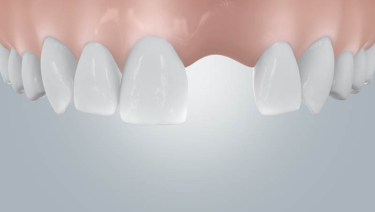 Implanty dentystyczne bez tajemnic